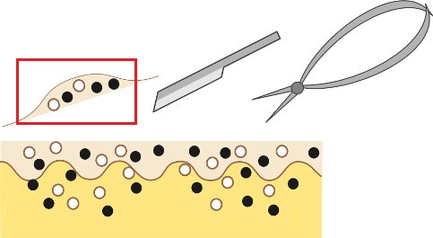 正しい削皮治療