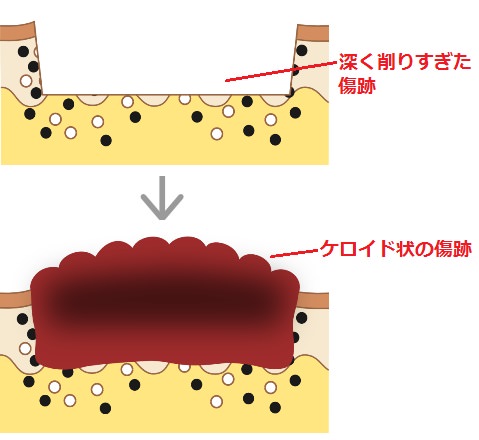 削りすぎによってケロイド状になった傷跡
