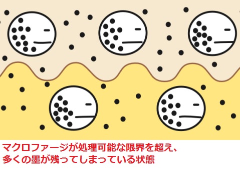 限界を超えたマクロファージ