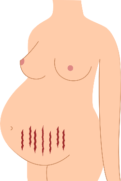 妊娠線