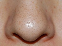 いちご鼻の原因と種類別の改善方法