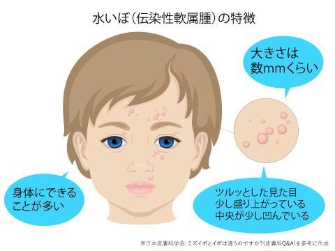 医師監修 水いぼを発症する原因と感染経路 スキンケア大学