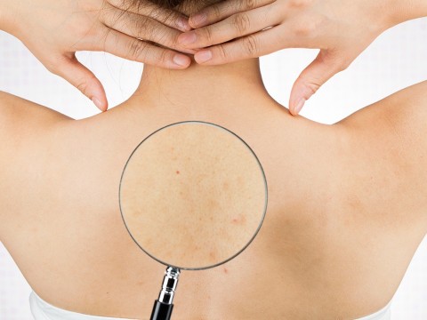 背中ニキビの皮膚科での治療方法の種類と効果