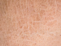 乾燥が原因 皮膚がピリピリ痛いときの化粧品選び スキンケア大学