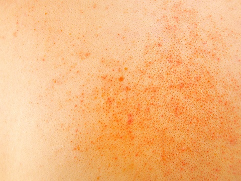 ハイドロキノンの効果を発揮するシミの種類