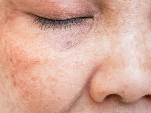 糖化した肌の特徴