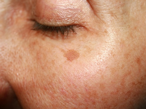 黄ぐすみの原因となる肌の糖化とは