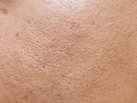 閉じない毛穴を引き締めるおすすめスキンケア