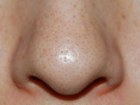 「いちご鼻」の治療に効果的な皮膚科のレーザー治療