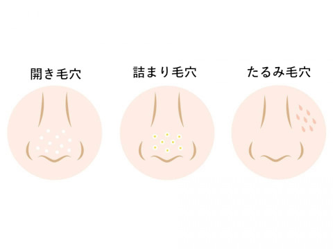 毛穴の種類のイメージ