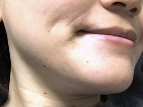 口元の乾燥小ジワ
