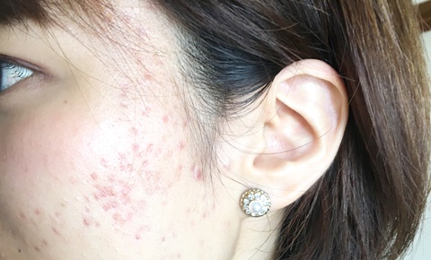 ニキビに「悩む女性