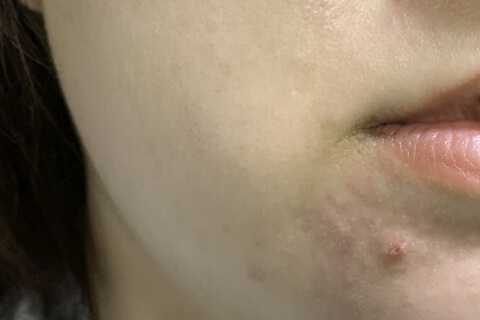 あごニキビイメージ