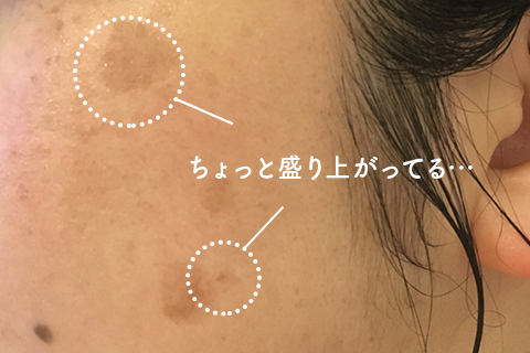 盛り上がったシミ