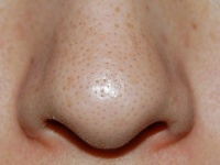 鼻の毛穴の開きの正しい対処法・治し方