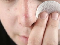 鼻の毛穴詰まりを解消する方法｜鼻の角栓を落とせる洗顔とケア