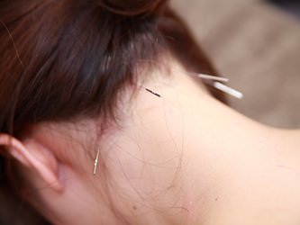 不妊の鍼灸・針治療の内容と効果