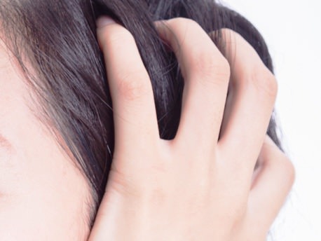 医師監修 頭皮のかさぶたの原因は 対処法やフケ かゆみを抑えるシャンプー方法 スキンケア大学