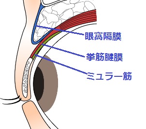 眼瞼挙筋腱膜短縮術