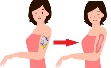女性のタトゥー除去と傷跡